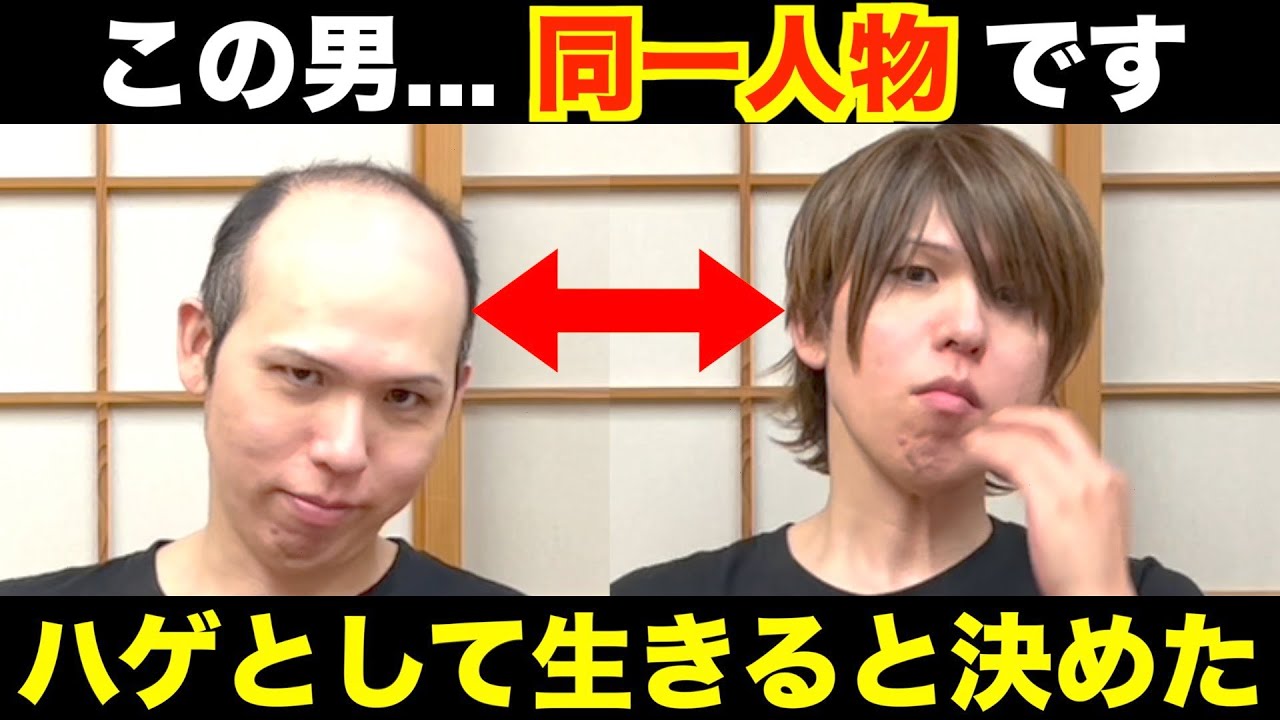 【元V系】ハゲを克服した経緯とは？〜ハゲとして生きると決めた〜
