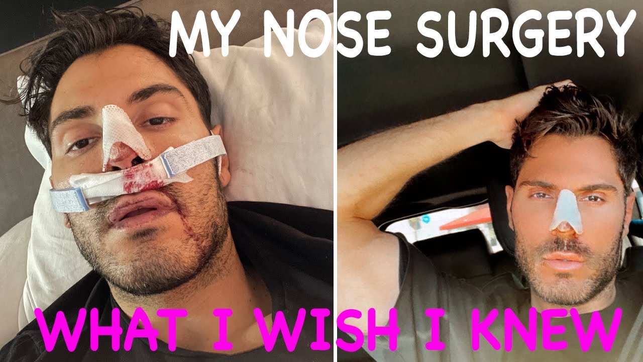 Nose Surgery: What I Wish I Knew