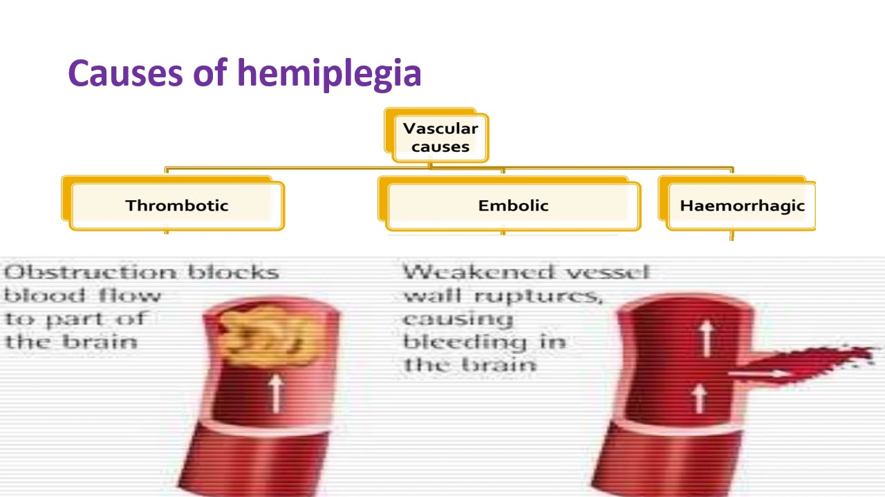 Hemiplegia for Clinical Round - By Dr. Mohammed Gamal Abdellatif (Neurology)