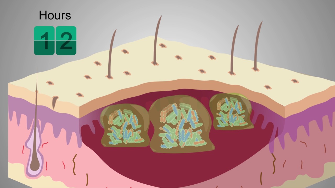 What are biofilms and how can wound healing be supported? - Prontosan is the answer