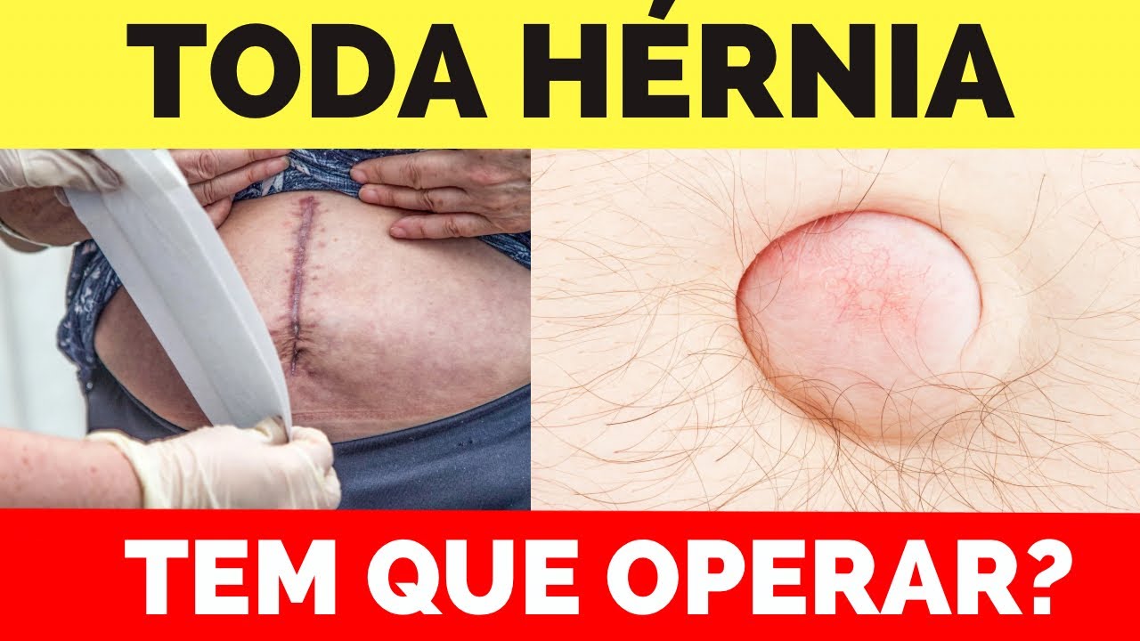 Quando se deve operar HÉRNIA ? Hérnia umbilical, hérnia inguinal e hérnia incisional