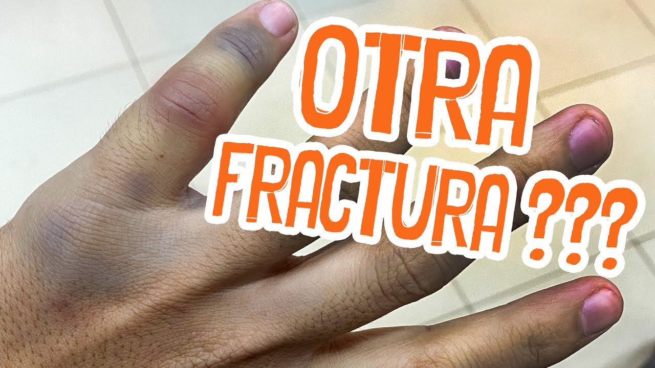 OTRA FRACTURA, no puede ser