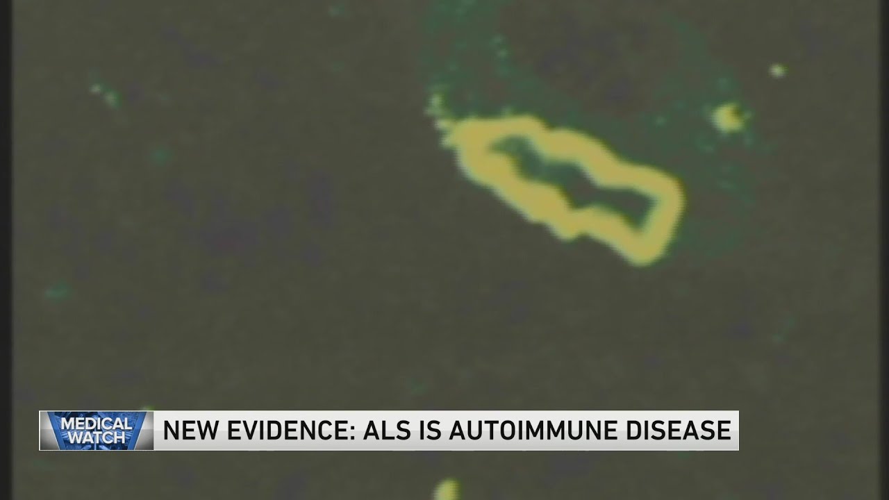 New evidence: ALS is autoimmune disease