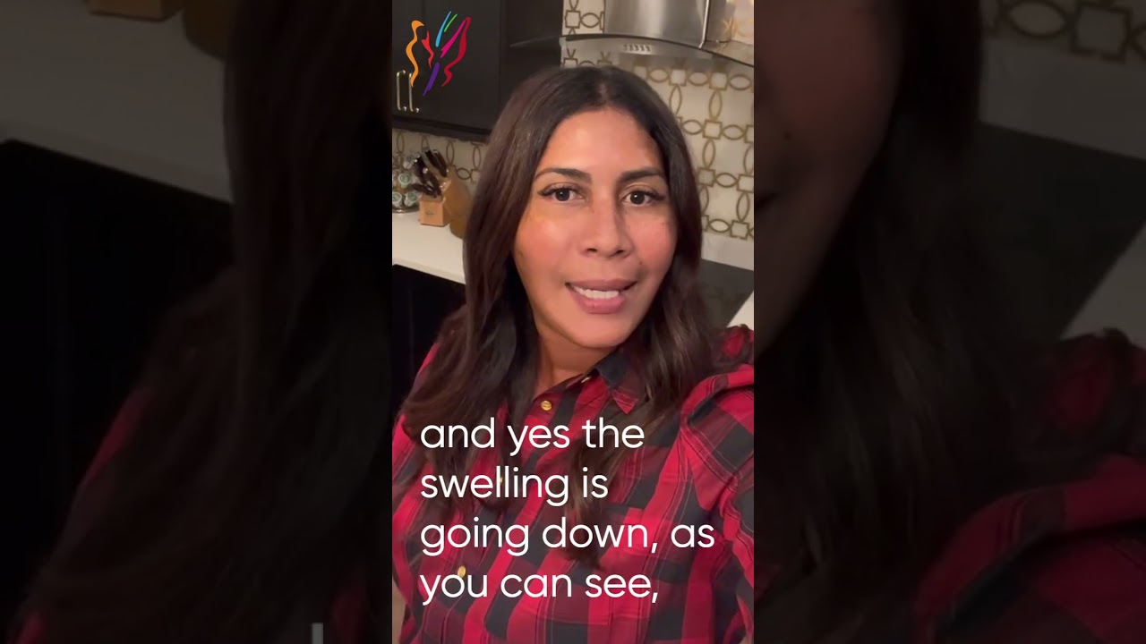 Advanced Facelift - Day by Day Actual Patient Recovery in Her Own Selfies