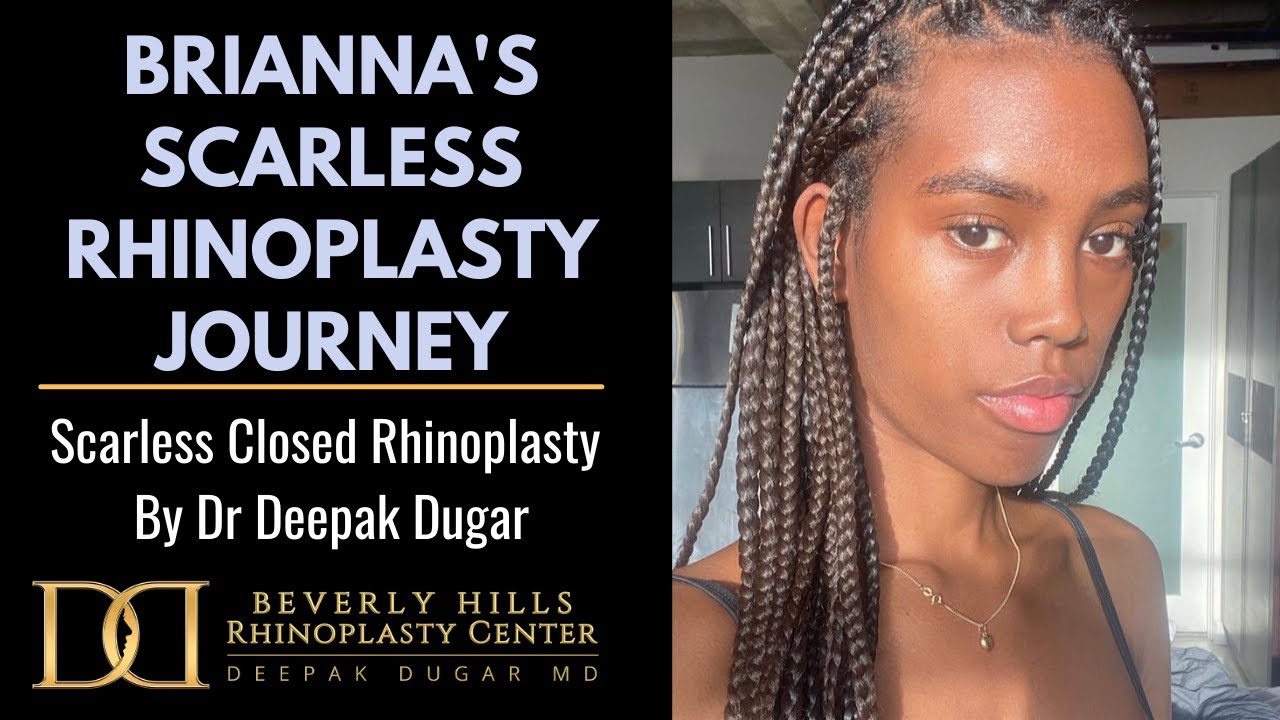 Brianna's (Ethnic Nose Job) Rhinoplasty Journey - Dr. Deepak Raj Dugar, Beverly Hills California