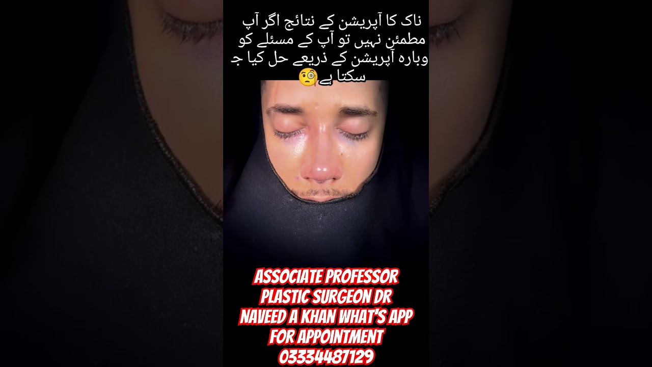 #MaleRhinoplasty#NoseSurgery#FacialSurgery#CosmeticSurgery#PlasticSurgery#MenBeauty#NoseJob