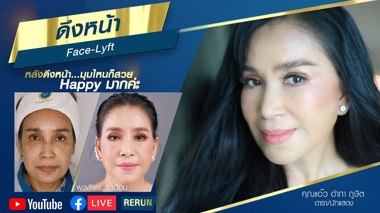 ผลลัพท์ของศัลยกรรมดึงหน้า ดึงคอ Face-Lyft ของคุณแอ๊ว อำภา ภูษิต‼️