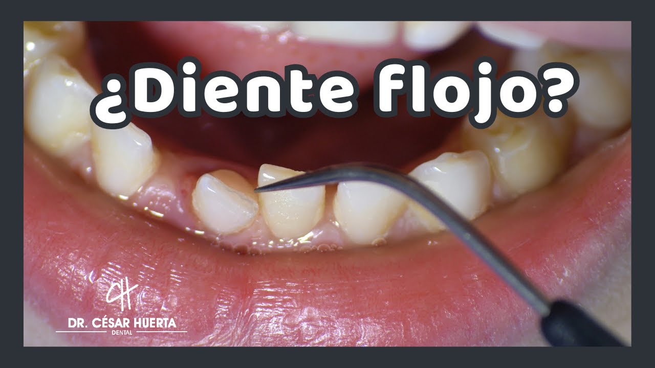 ¿Tienes un diente flojo? - Movilidad dental