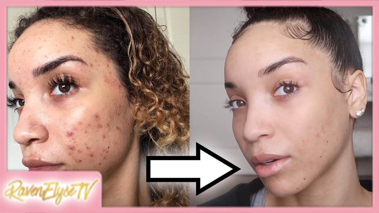 My Current Skincare Routine + Accutane/Acne Update!