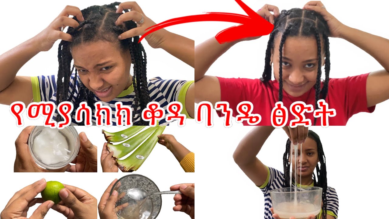 ፀጉሬን ካሳከከኝ ፎሮፎርም ካለው እንደዚ ነው ፅድት ማደርገው የማድሰው//dandruff homemade remedy
