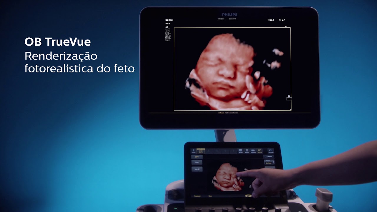 Philips: Nova Gera&ccedil;&atilde;o de Ultrassom Premium EPIQ ELITE