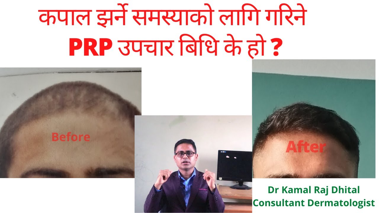 PRP treatment for hair loss in Nepal by Dermatologist Dr Kamal Raj Dhital | hair transplant in nepal