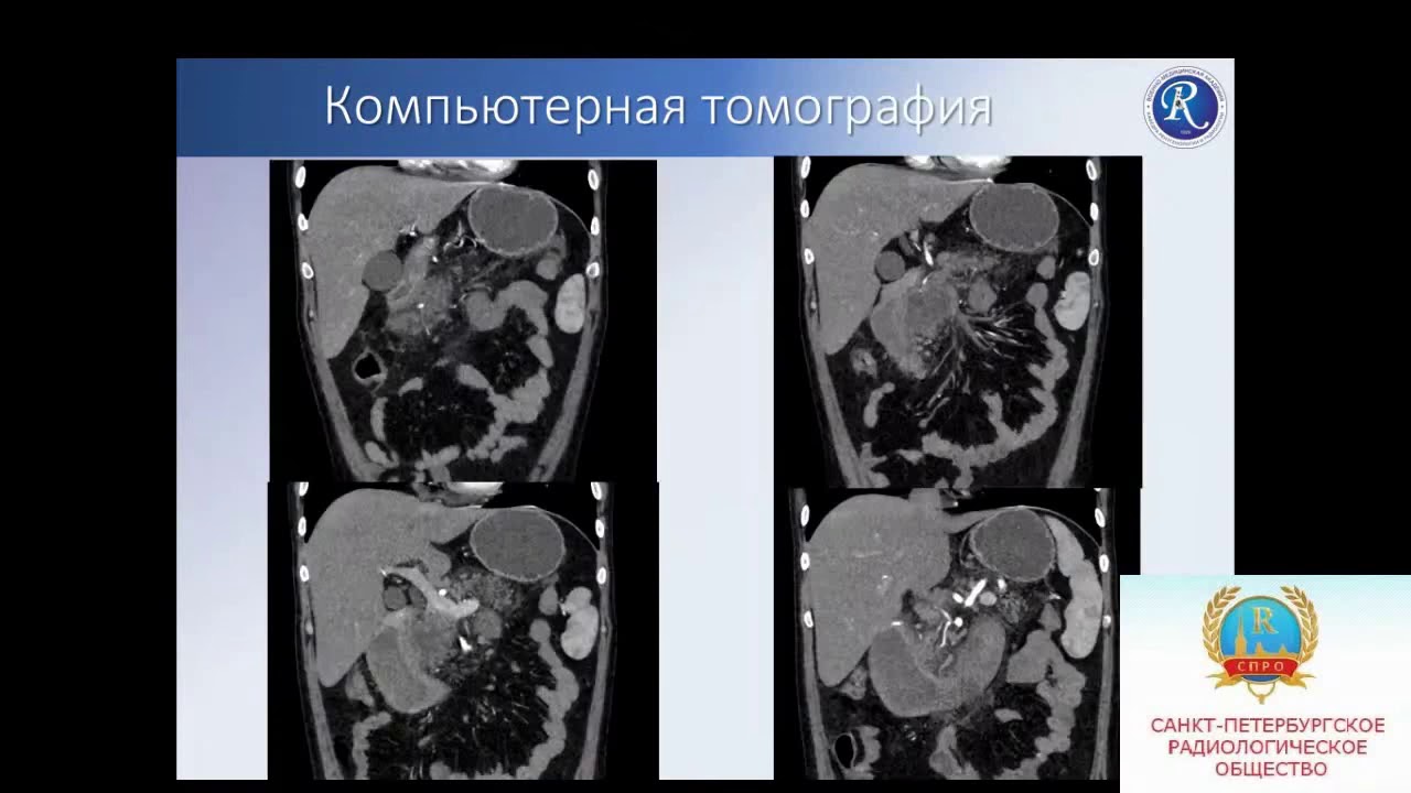 Некрасова М.Н. «КТ-картина парадуоденального (groove) панкреатита»