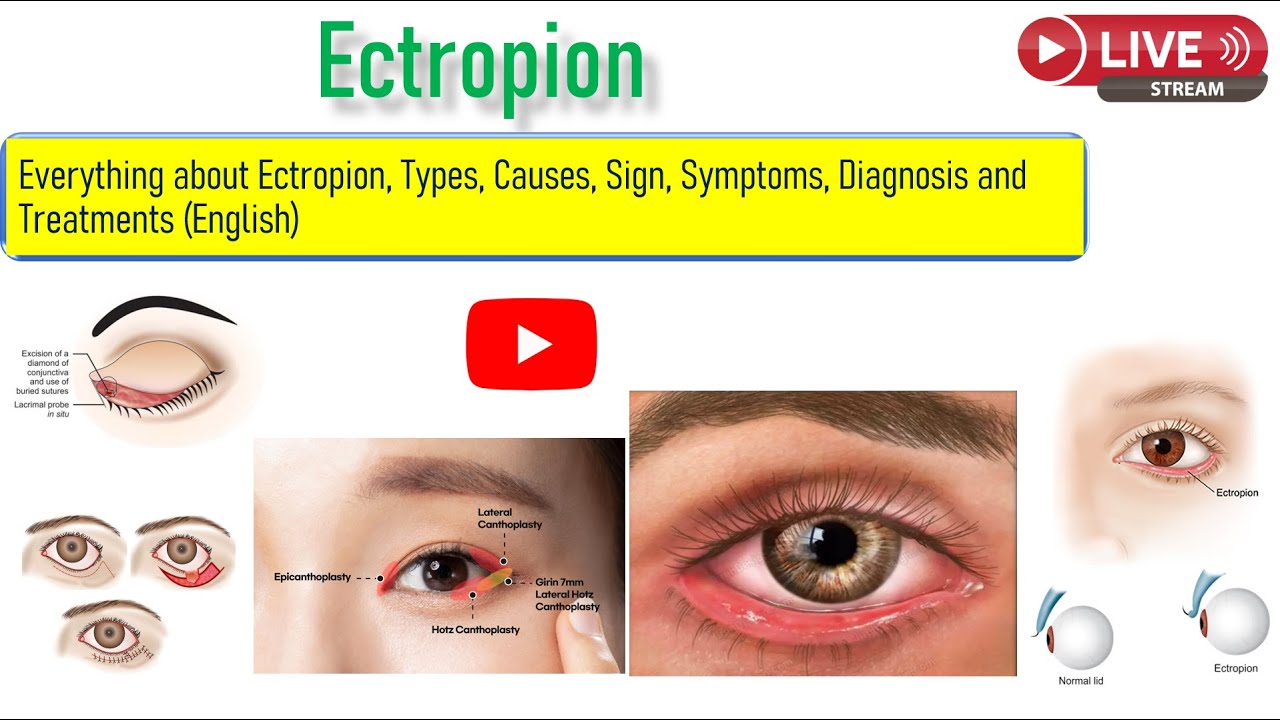 Everything about ectropion, Types, Sign, Symptoms and Treatment option including surgury