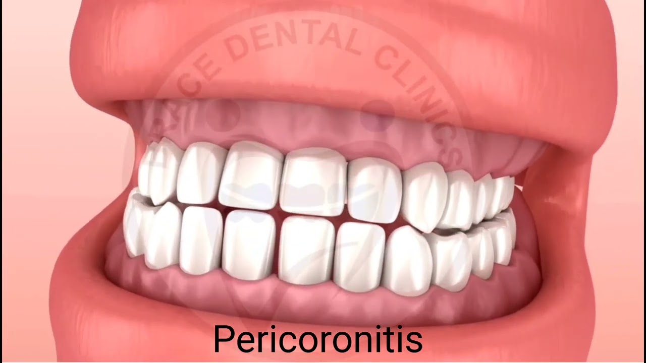 What is #Pericoronitis? When is Operculectomy? --Brace Dental Clinics