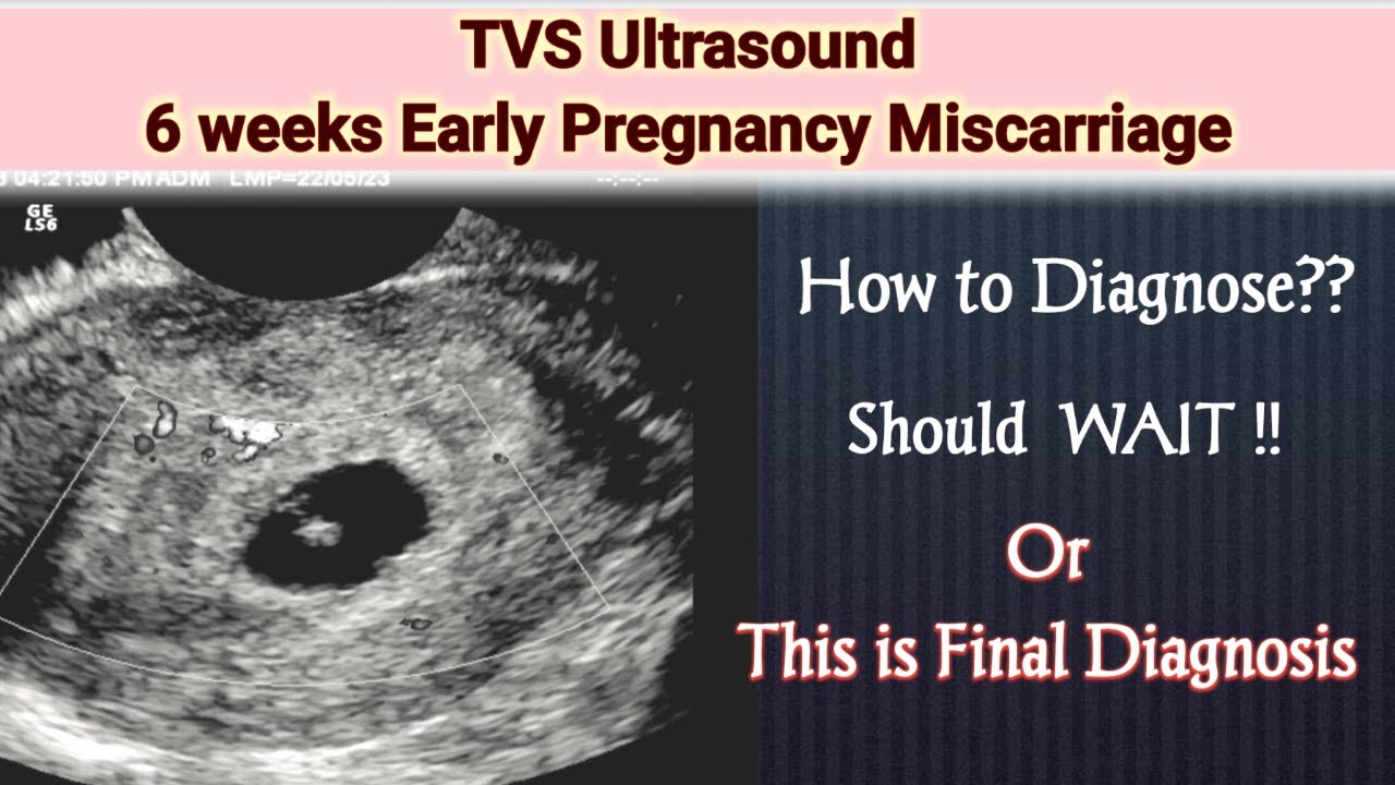 6wks Early Pregnancy Miscarriage | Missed Abortion