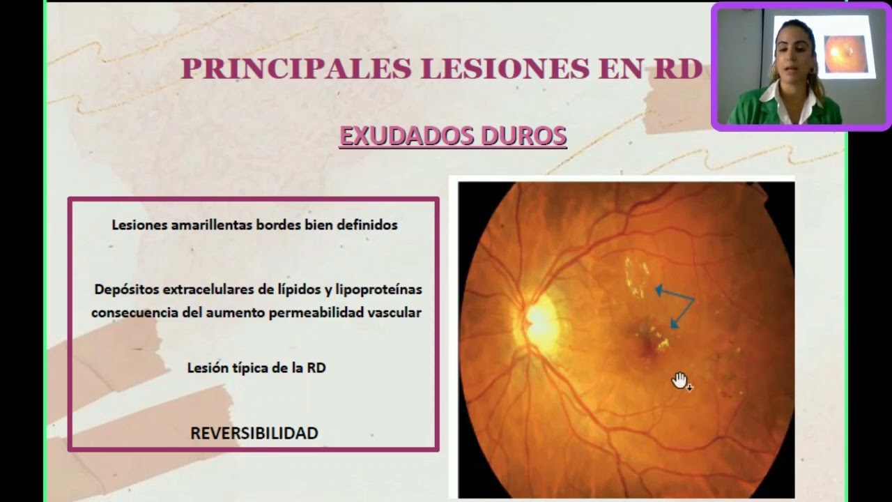 Retinograf&iacute;a en AP: retinopat&iacute;a diab&eacute;tica.