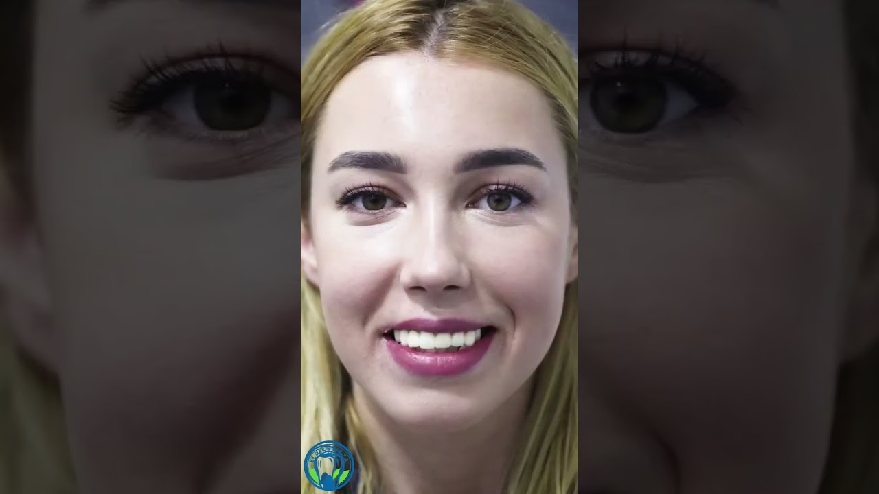 Smile Makeover &ndash; Before & After Hollywood Smile Transformation #smiledesigndental #smilemakeover