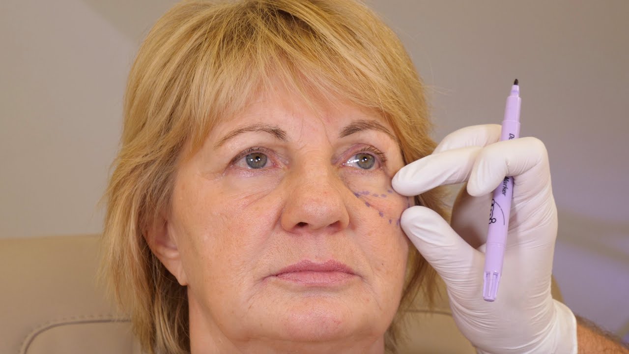 Mini-Facelift ohne OP mit AGNES Radiofrequenz