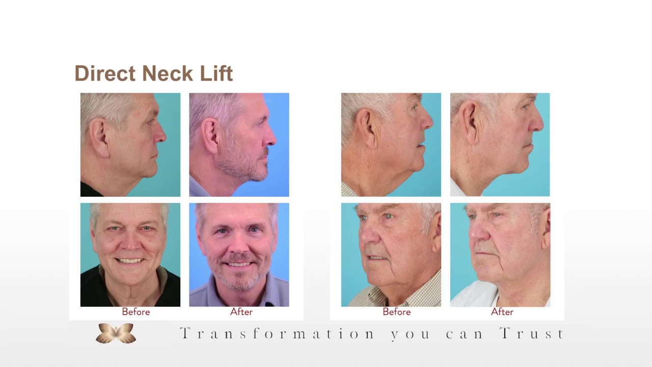 Direct Necklift Seminar by Dr. Douglas Henstrom - Utah Facial Plastics