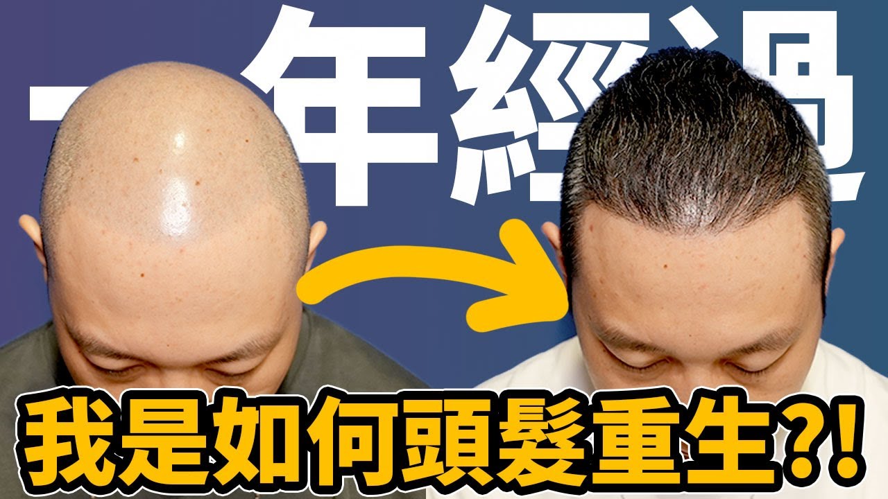 我是如何頭髮重生😲？！所有脫髮煩惱男士必看影片🔥！