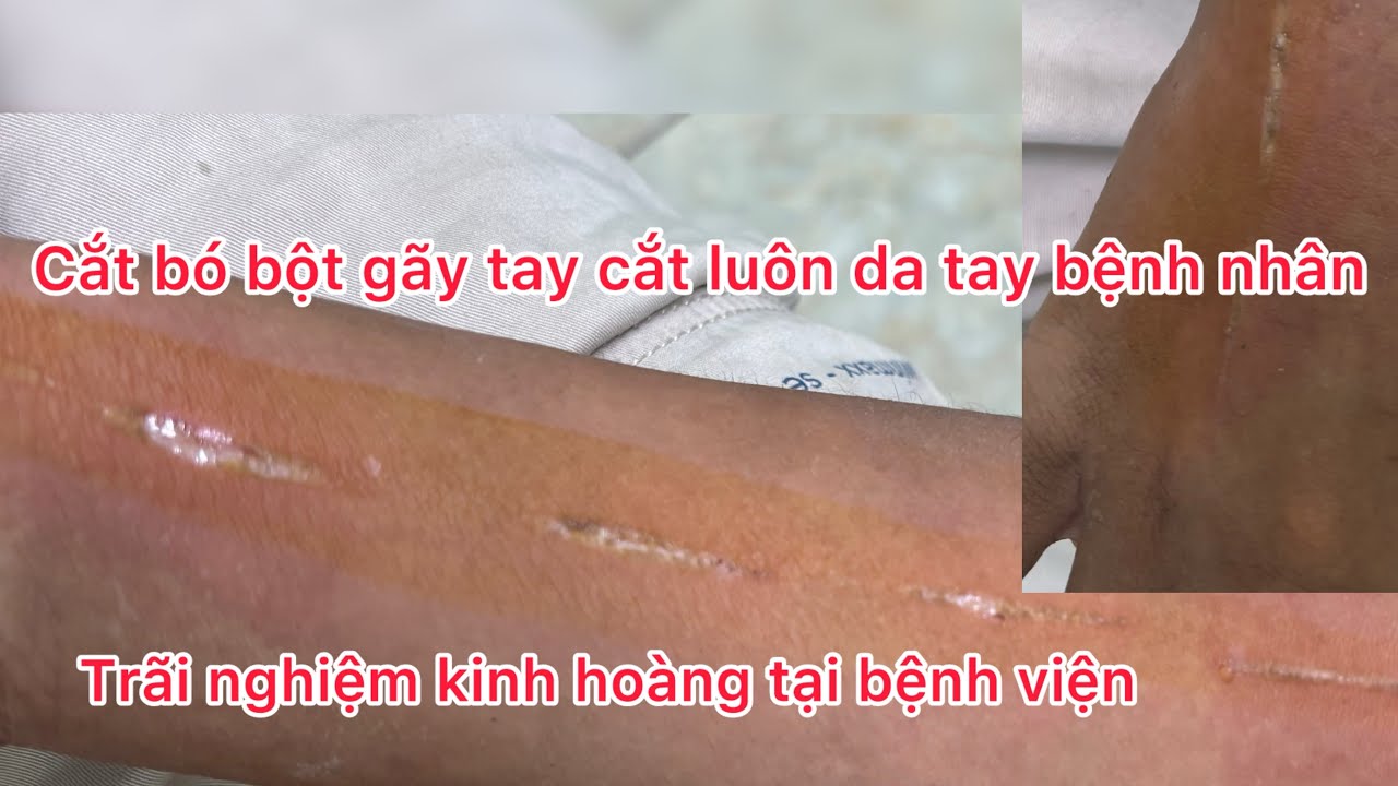 Sai lầm của nhân viên y tế #vietnam dẫn đến hậu quả nghiêm trọng và tốn thương tới bệnh nhân nhi.