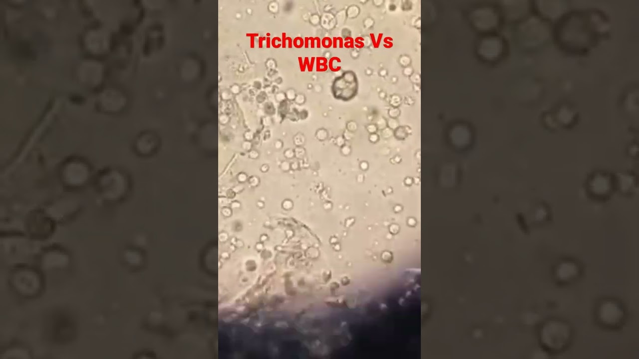 #trichomonas