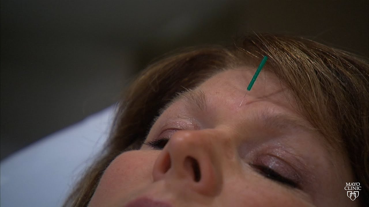 Mayo Clinic Minute: Acupuncture and Athletic Performance