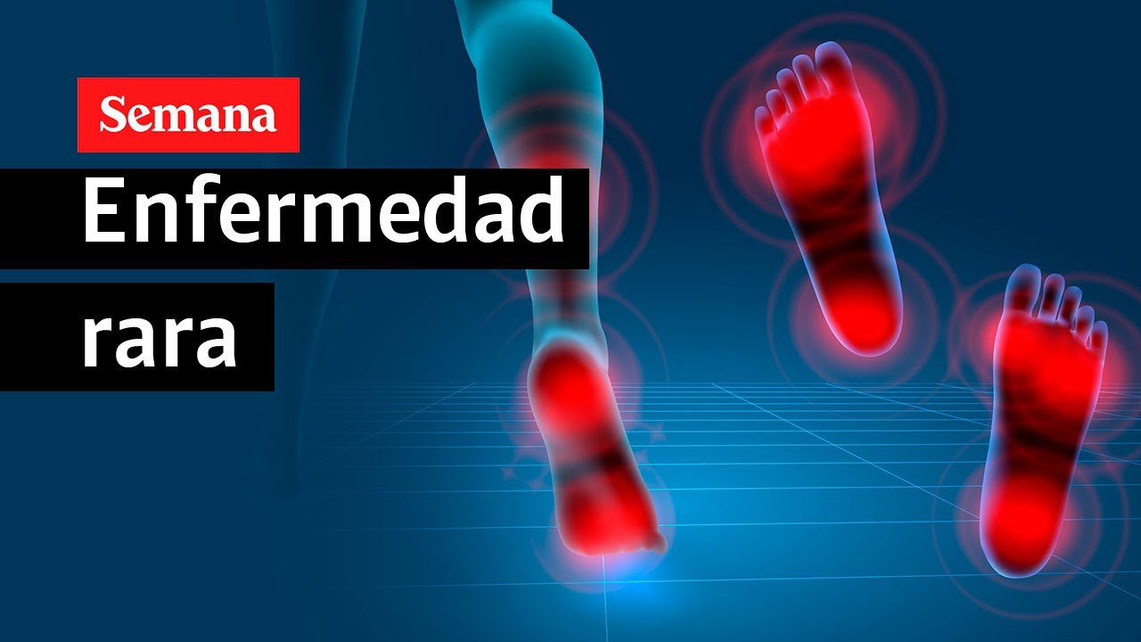 ¿En qué consiste el raquitismo hipofosfatémico ligado al cromosoma  X?