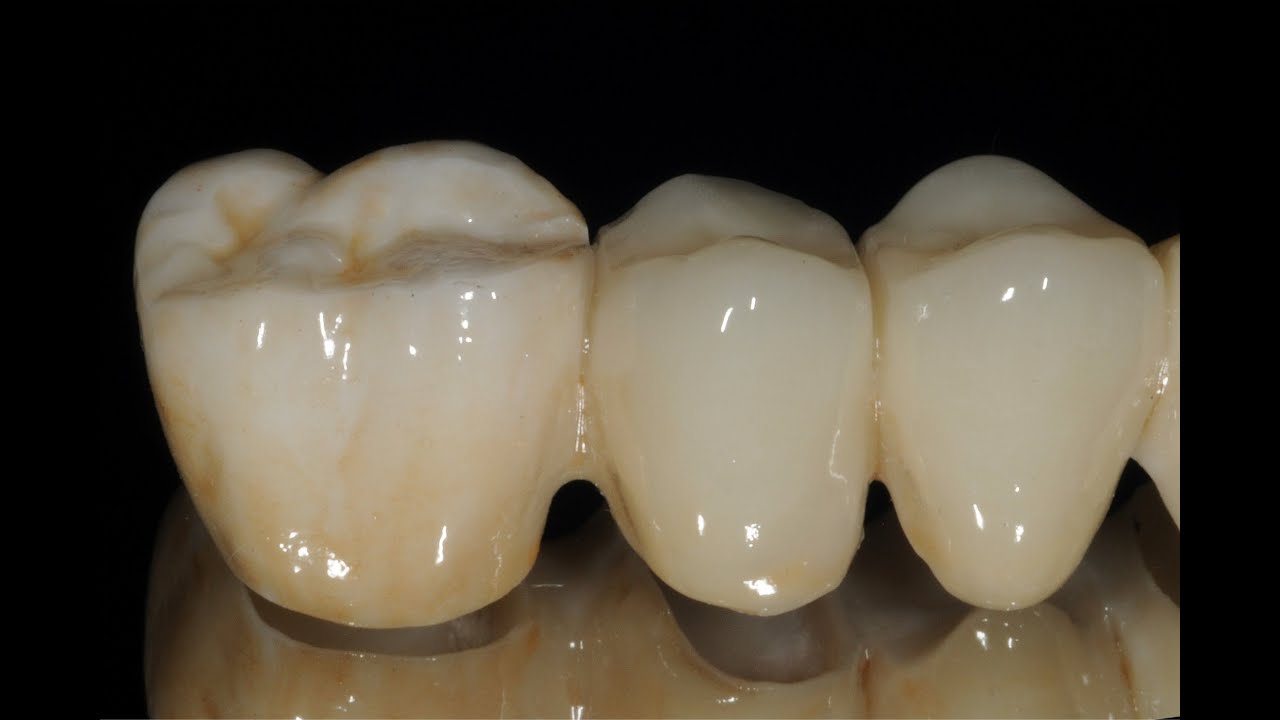 Design tips to avoid zirconia bridge fracture
