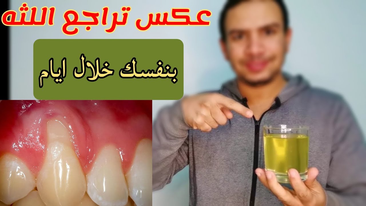 سر تراجع اللثه الذي لا يخبرك به أحد كيف تعكس تراجع اللثه بنفسك