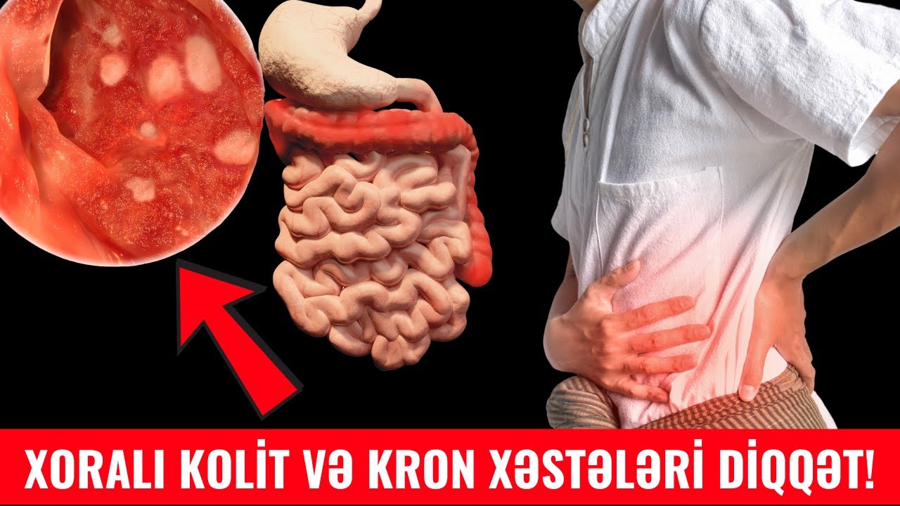 Xoralı kolit və kron xəstələri pəhriz saxlamalıdır?