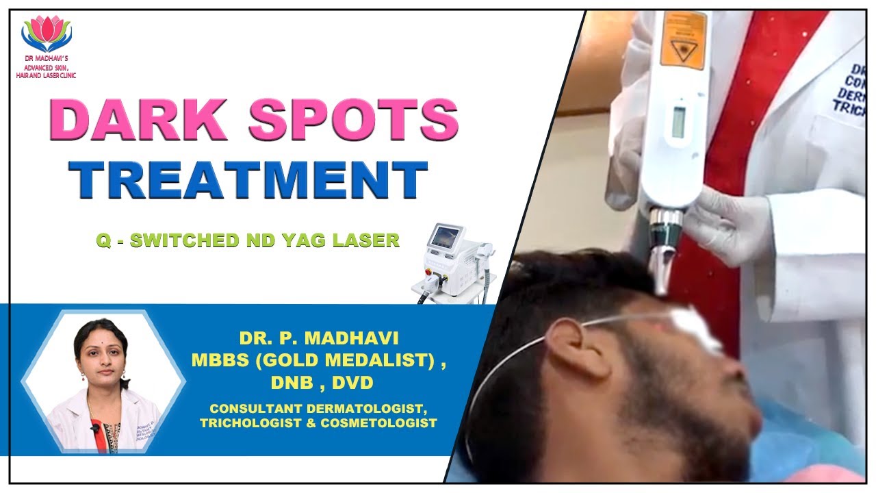 Dark Spots Treatment with Q Switched Nd YAG laser | Dr.Madhavi's Advanced Skin Hair & Laser Clinic