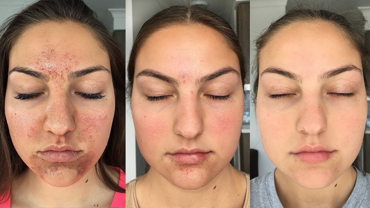 My Accutane Experience + How I Got Clear Skin (Before + After Pictures)