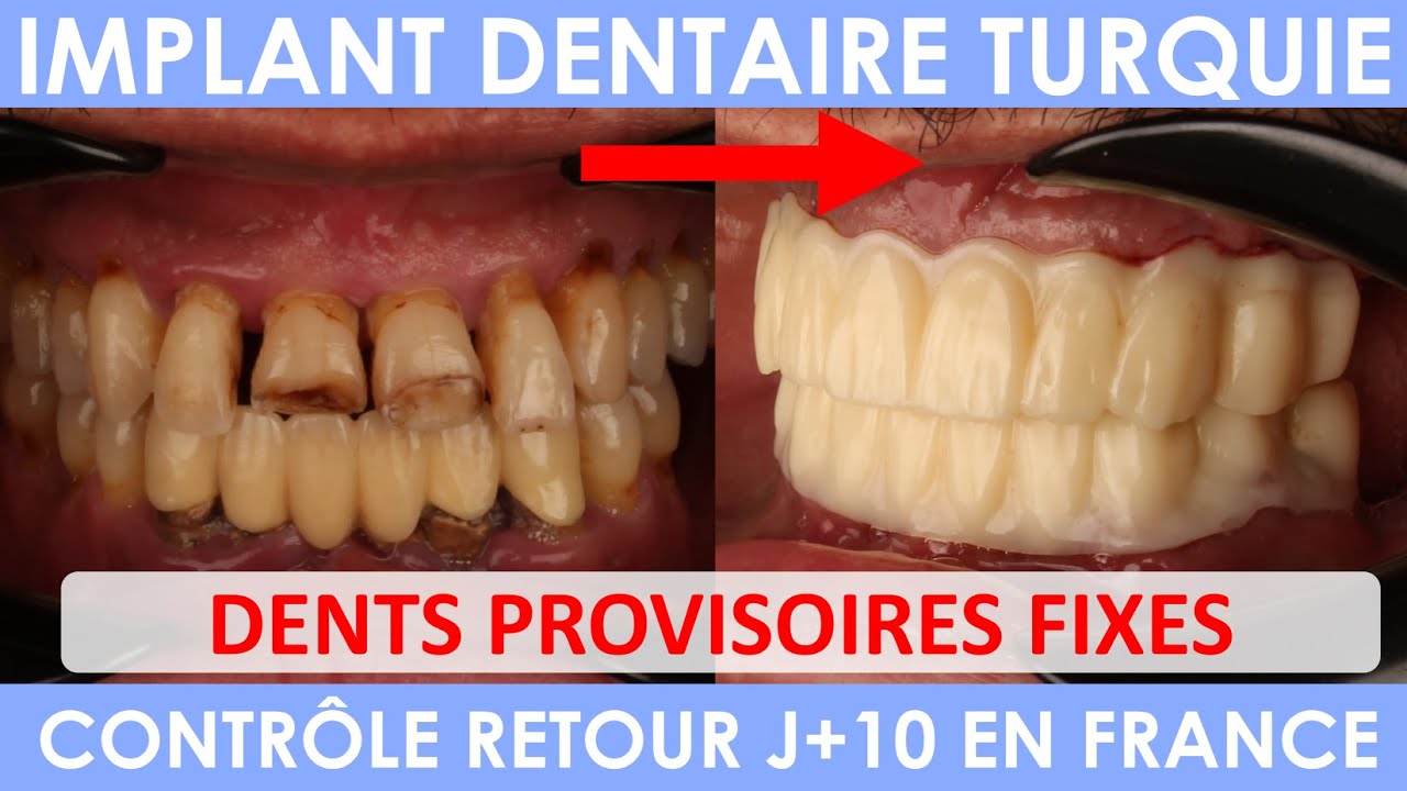 Implant dentaire Turquie - Suivi post opératoire Paris - Belkacem