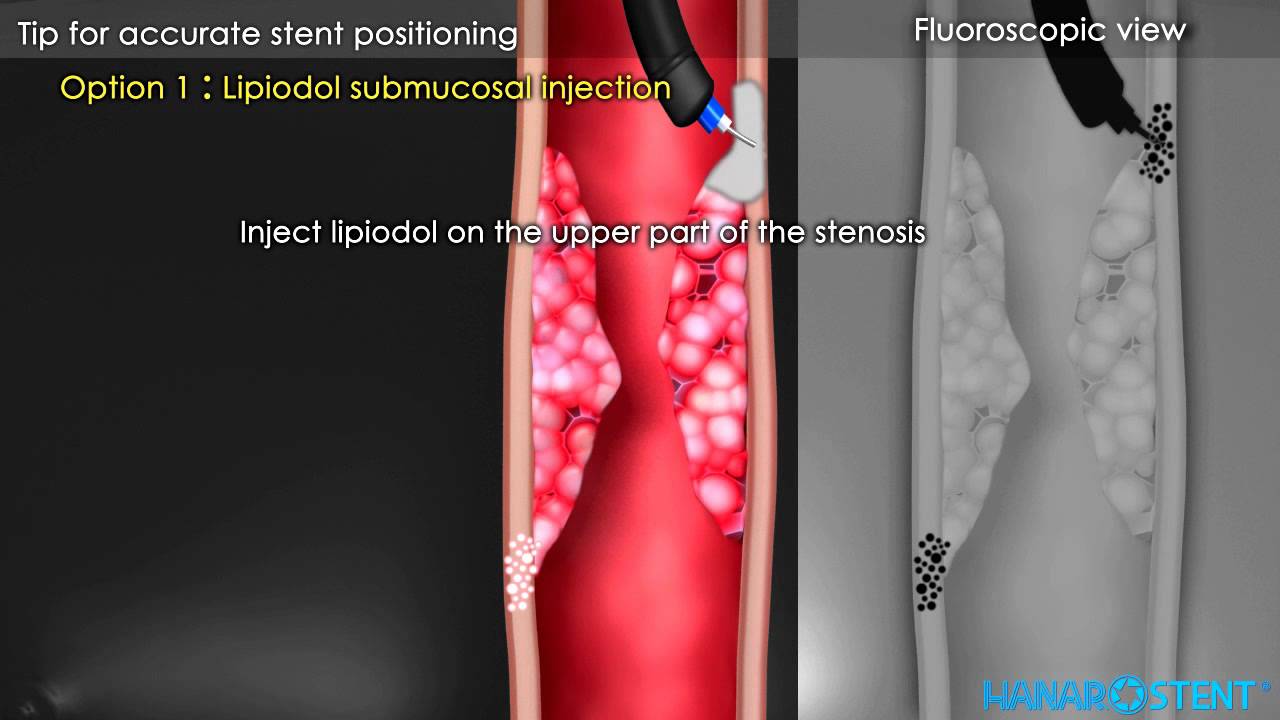 Hanaro Oesophageal Stents Demonstration Video
