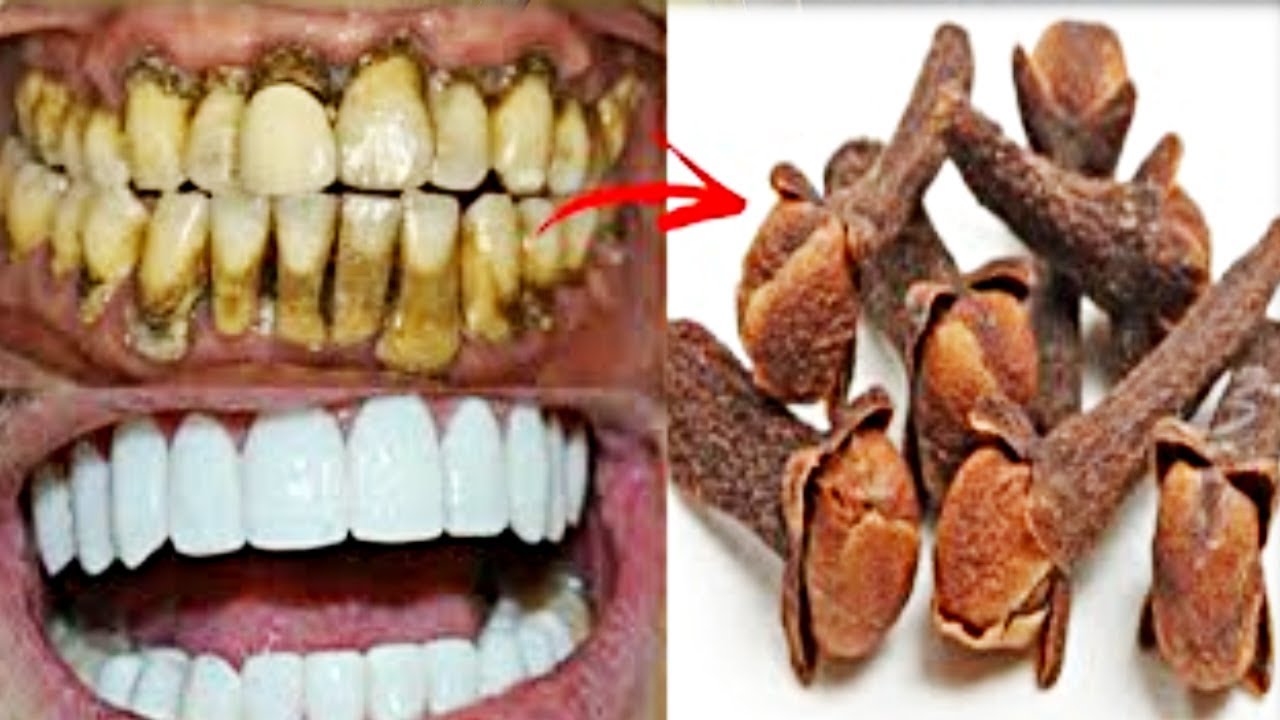 உடனே மஞ்சள் பற்கள் வெள்ளையாக வாய் துர்நாற்றம் சரியாக | yellow teeth to white teeth tips | cavity tip
