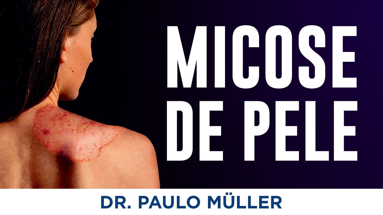 Micoses de Pele – Dr. Paulo Müller Dermatologista.