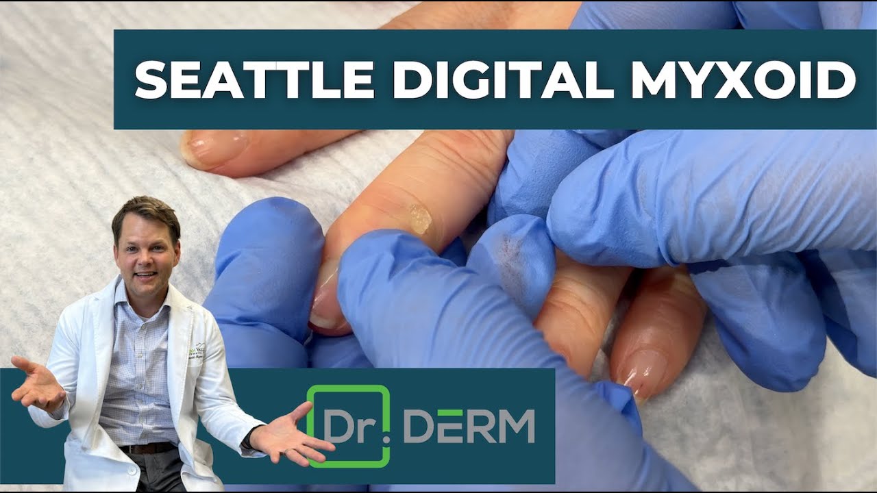 Digital Myxoid from Seattle | Dr. Derm