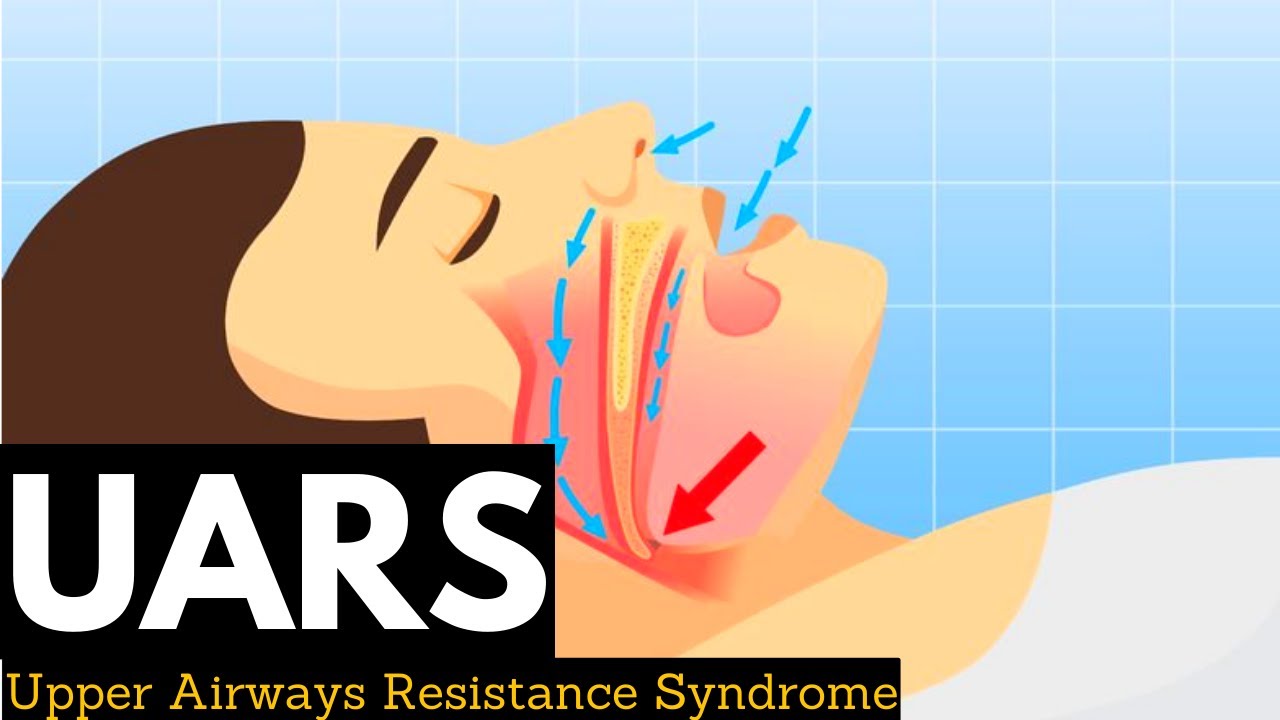 Upper Airway Resistance Syndrome (UARS)