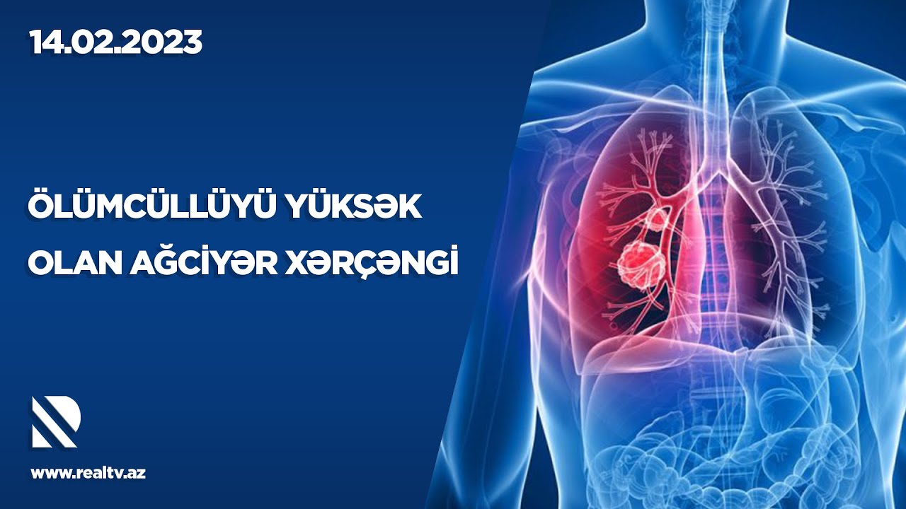 Ölümcüllüyü yüksək olan ağciyər xərçəngi - BAŞ HƏKİM