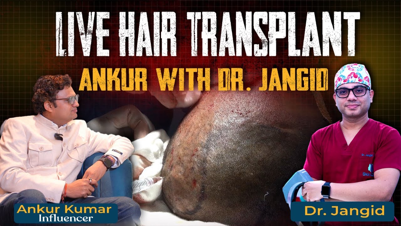 Hair Transplant Explained LIVE | Explained by Dr. Jangid | Delhi Best Clinic