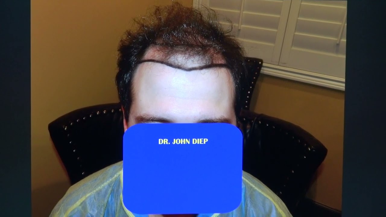 Hair Loss Treatment for Men | [Type of transplant] (# Hair grafts)