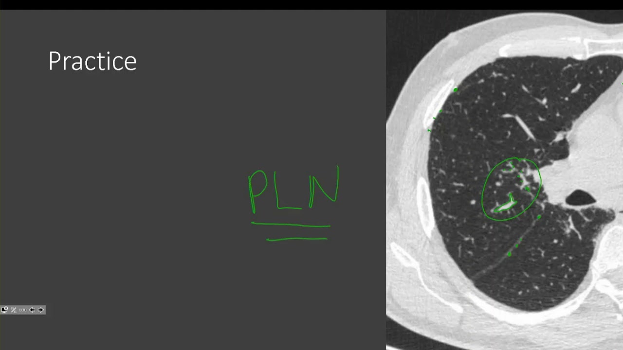 Micronodular lung disease Part 2