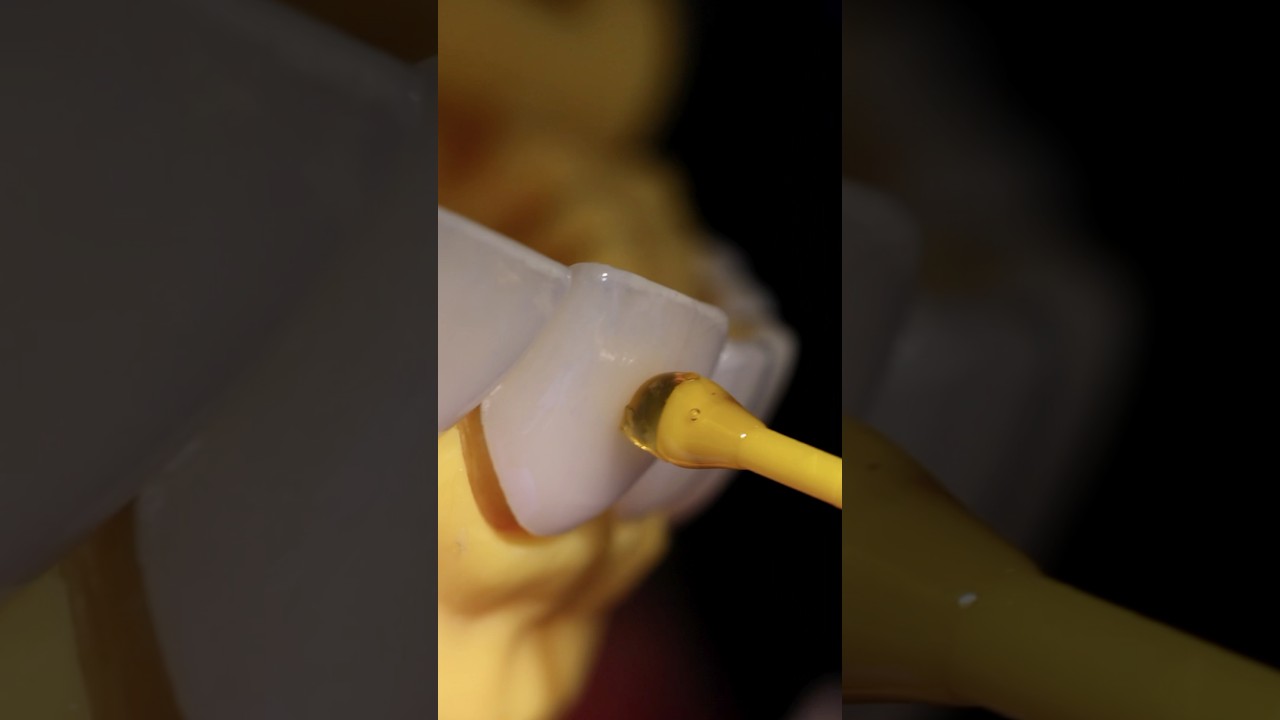 CARILLAS EN PORCELANA🦷Tu sonrisa se transforma en una aut&eacute;ntica obra de arte #smile #carillas