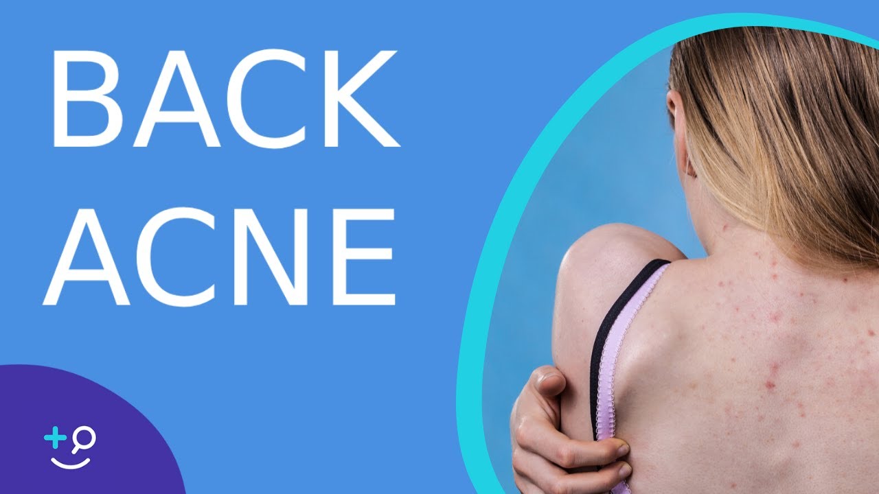 Back Acne - Why do we get it and how to treat it