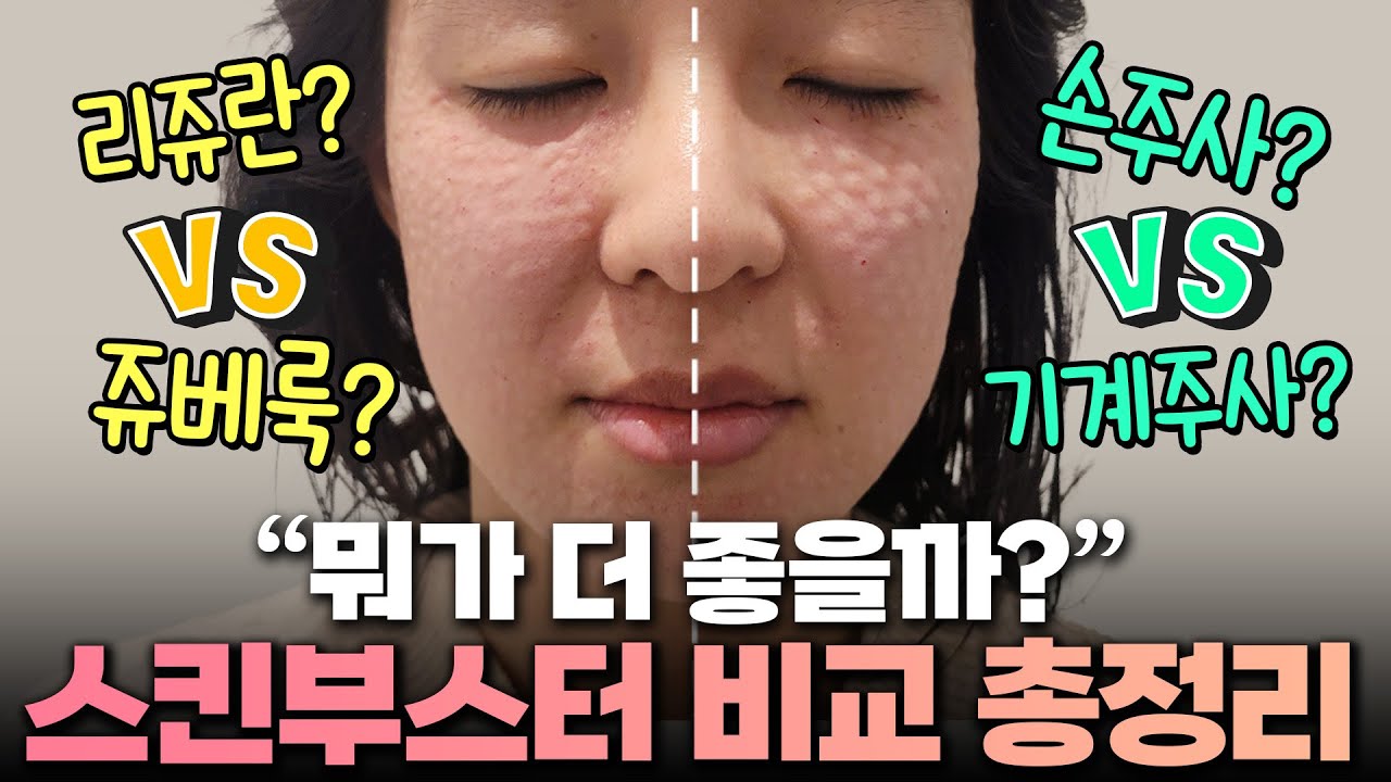 얼굴 절반씩 직접 맞아본 스킨부스터 비교실험! 리쥬란 vs 쥬베룩, 손주사 vs 기계주사 뭐가 더 좋을까요?
