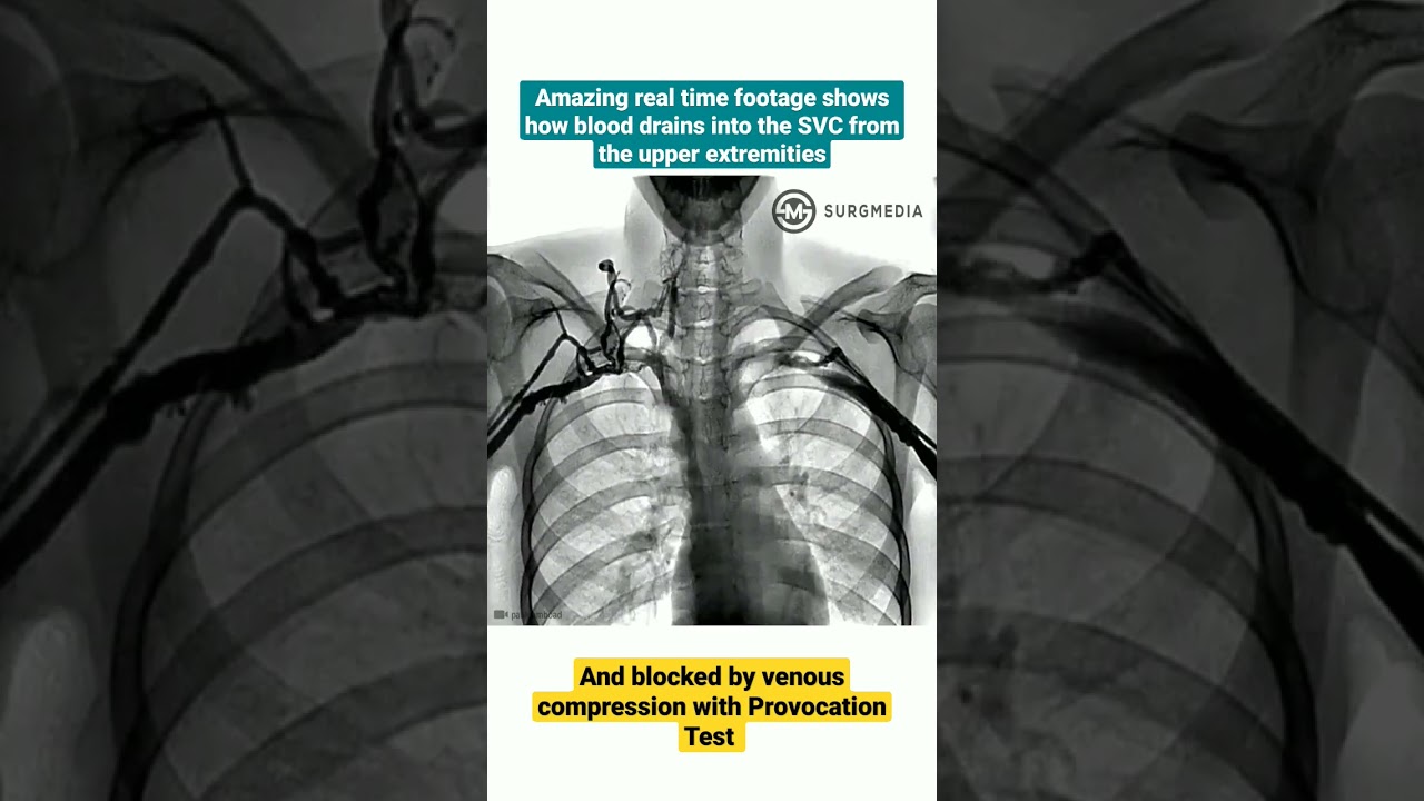 Real time footage shows how blood drains into the SVC from the upper extremities. #doctor #Shorts