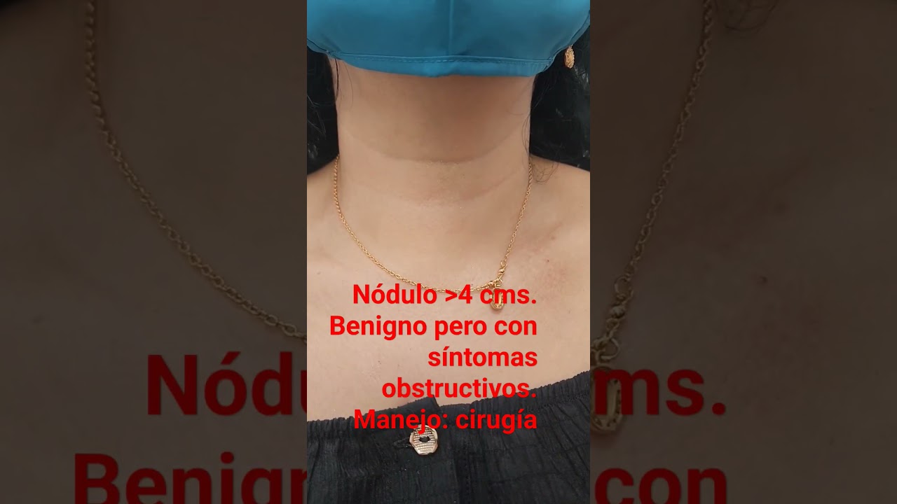N&oacute;dulo tiroideo de 4 cms. Es benigno pero esta generando s&iacute;ntomas obstructivos. Manejo con cirug&iacute;a