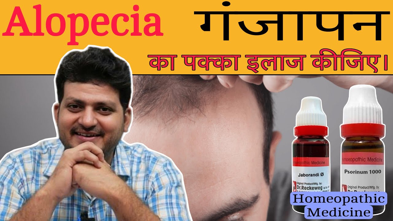 Alopecia गंजापन | Best Homeopathic Medicine | How to Use |